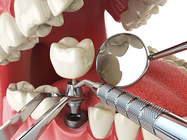 Best Lost Filling or Crown Replacement in Mount Plymouth, FL